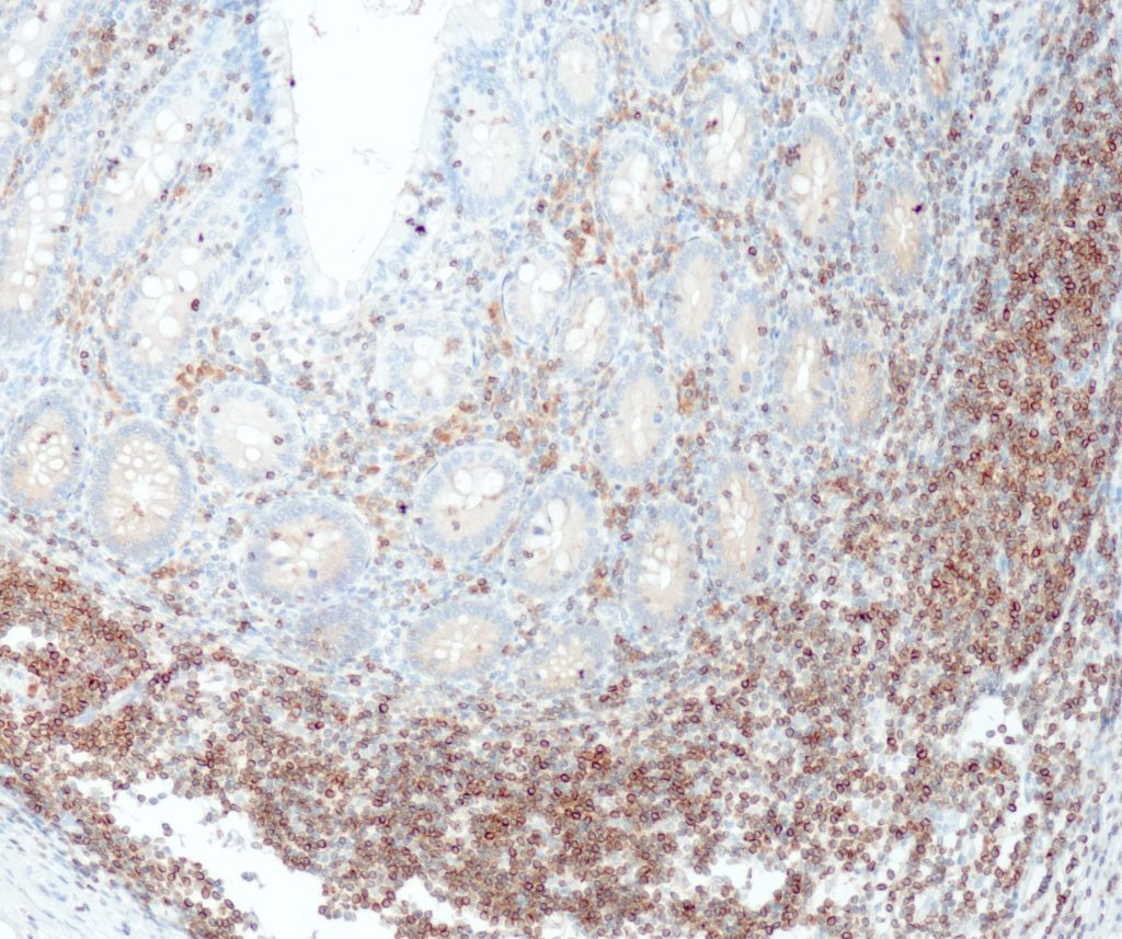 Human appendix stained with anti-Bcl2 (QR062).