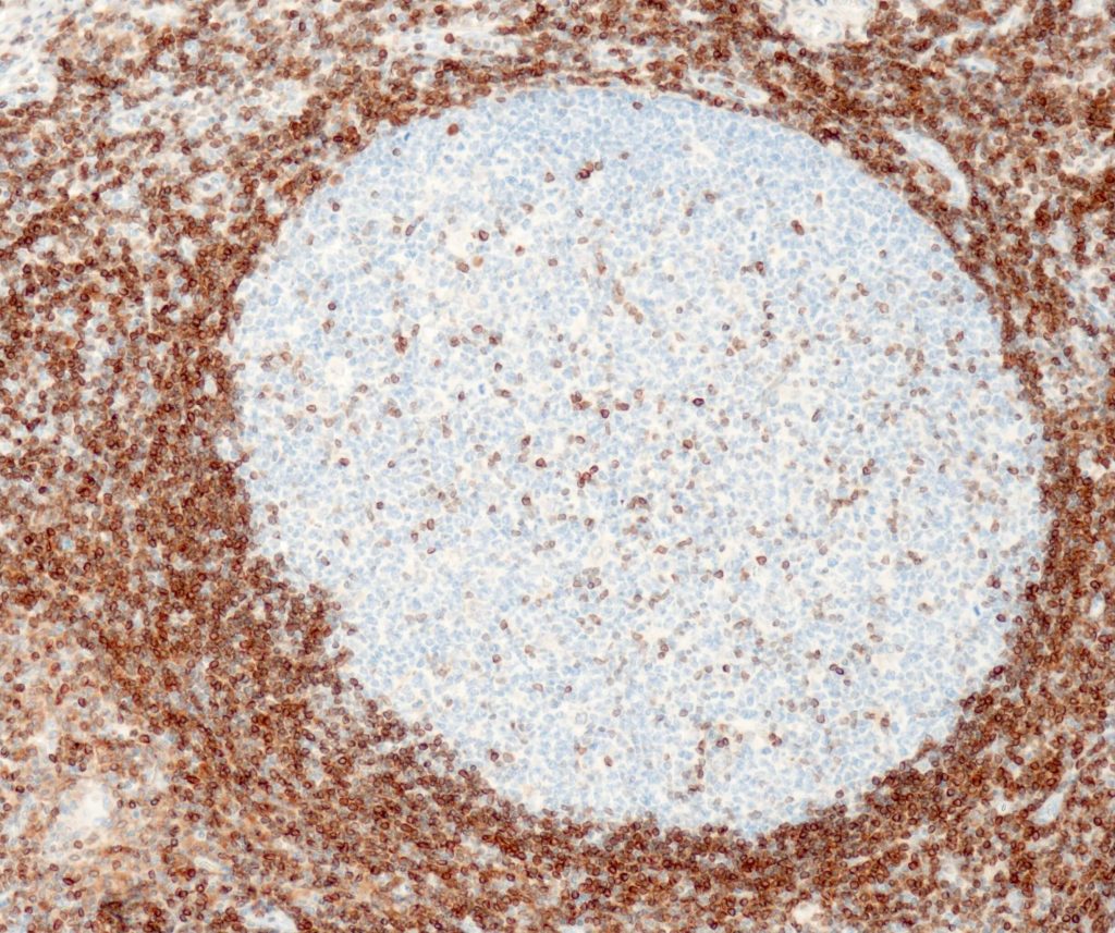 Humane Tonsille gefärbt mit Anti-Bcl2 (QR062) - Zytoplasma- und Membranfärbung von Mantel-B-Zellen und peripheren T-Zellen. In den Keimzentren zeigen verstreute T-Zellen eine deutliche Reaktion, während die B-Zellen negativ sind.