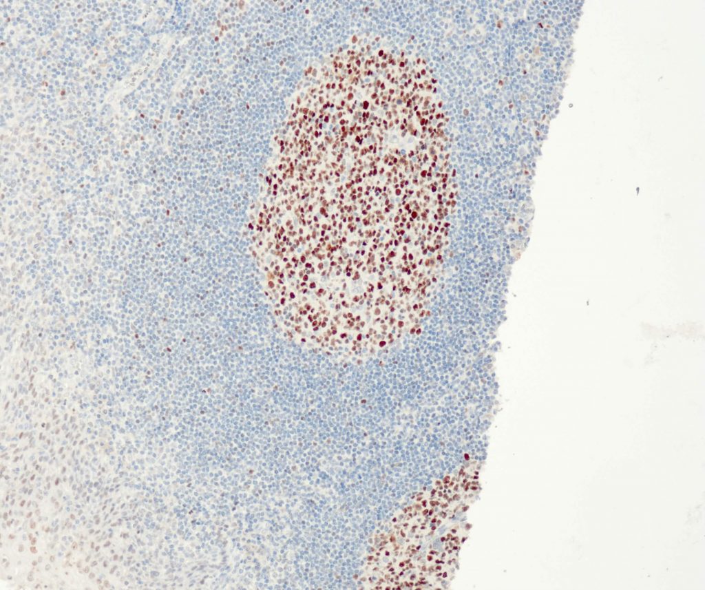 Humane Tonsille gefärbt mit Anti-Bcl6 (QR047) - Kernfärbung von B-Zellen im Follikelzentrum.