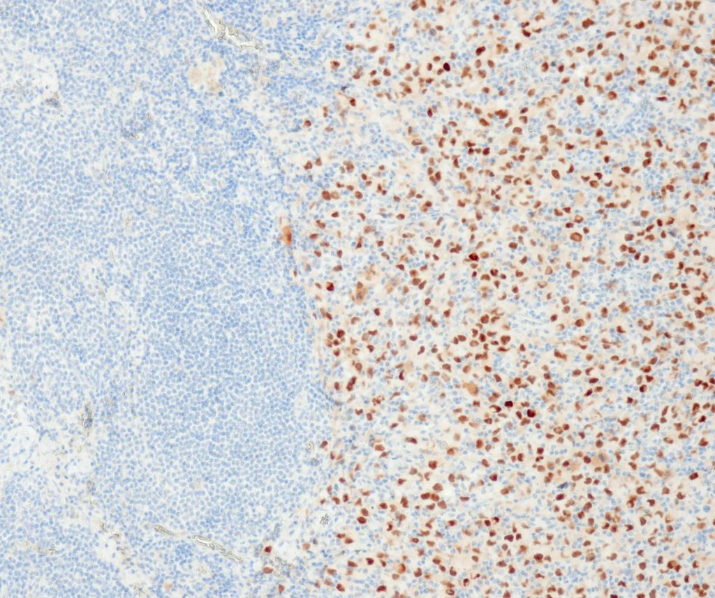 Humanes Melanom gefärbt mit Anti-PRAME (QR005) - starke Kernfärbung der Tumorzellen.
