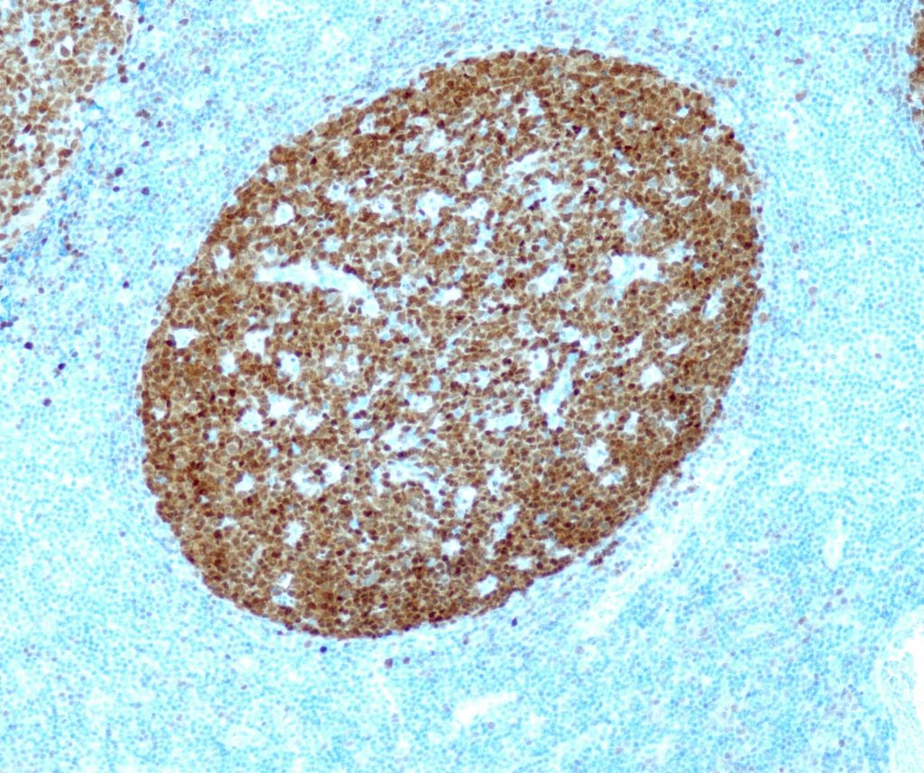 Humane Tonsille gefärbt mit Anti-BOB.1 (QR072) - Kern- und Zytoplasmafärbung von B-Zellen im Follikelzentrum.