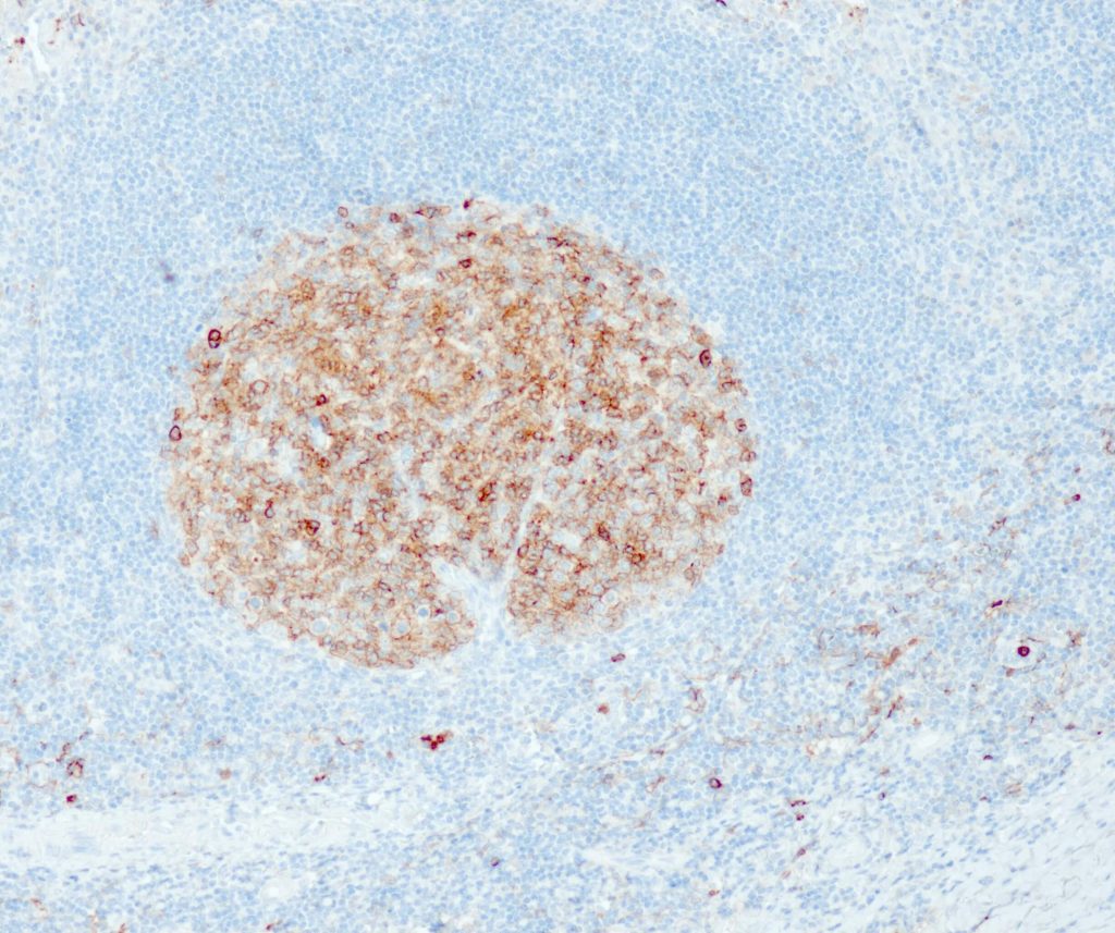 Humane Tonsille gefärbt mit Anti-CD10 (QR021) - deutliche Membranfärbung aller B-Zellen des Keimzentrums, B-Zellen der Mantelzone sind negativ, vereinzelte Stromazellen zeigen eine schwache Membranfärbereaktion.