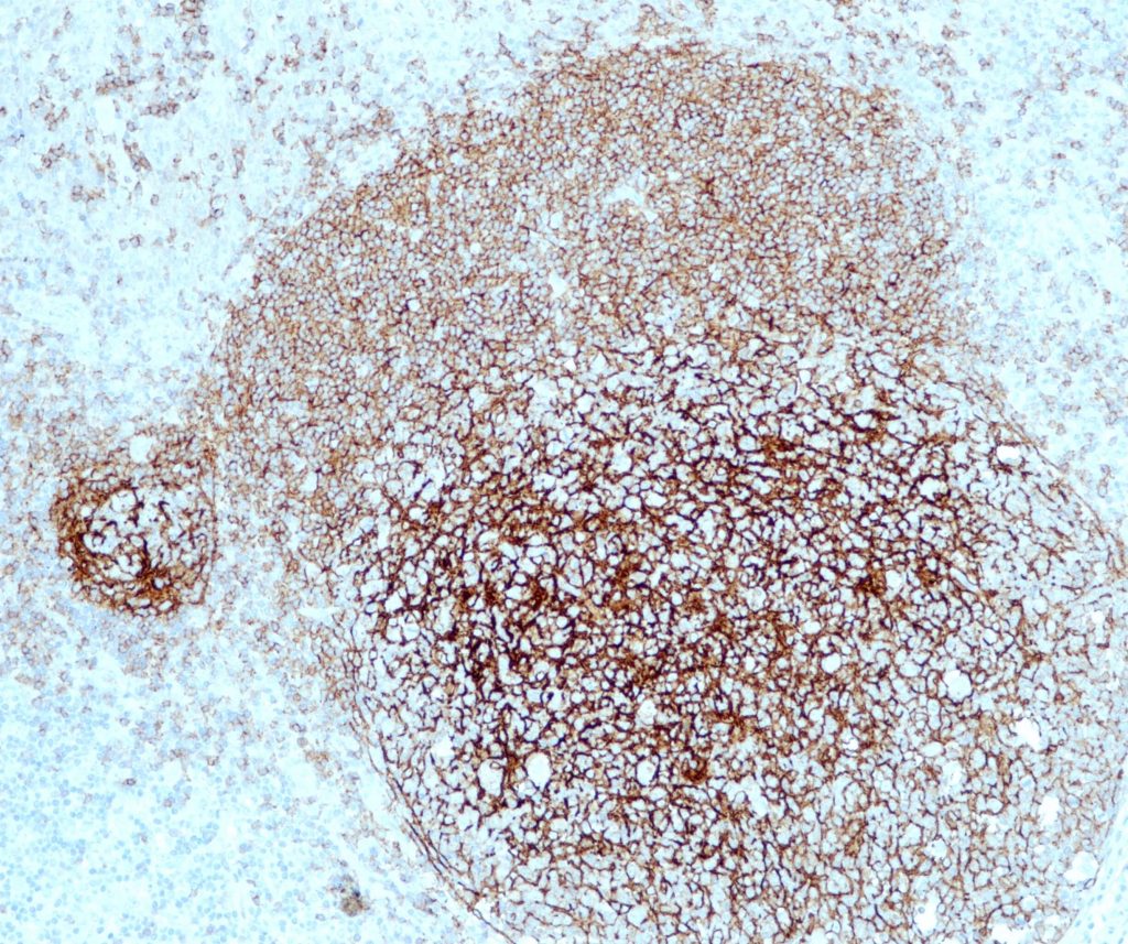 Humane Tonsille gefärbt mit Anti-CD21 (QR076) - Membranfärbung von follikulären dendritischen Zellen.