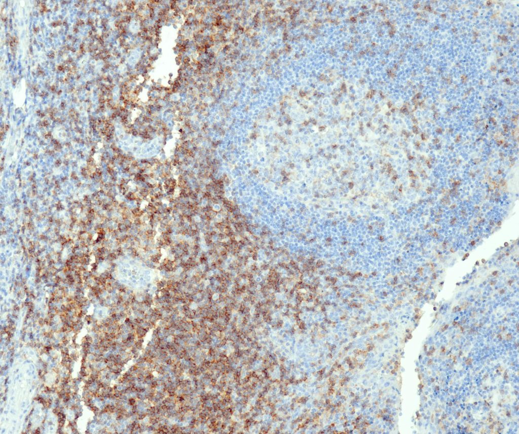 Humane Tonsille gefärbt mit Anti-CD4 (QR032) - starke und deutliche Membranfärbung aller Helfer-/Induktor-T-Zellen, mäßige und deutliche Membranfärbung von Keimzentrumsmakrophagen, andere Zellen sind negativ (einschließlich B-Zellen und Epithelzellen der Tonsille).