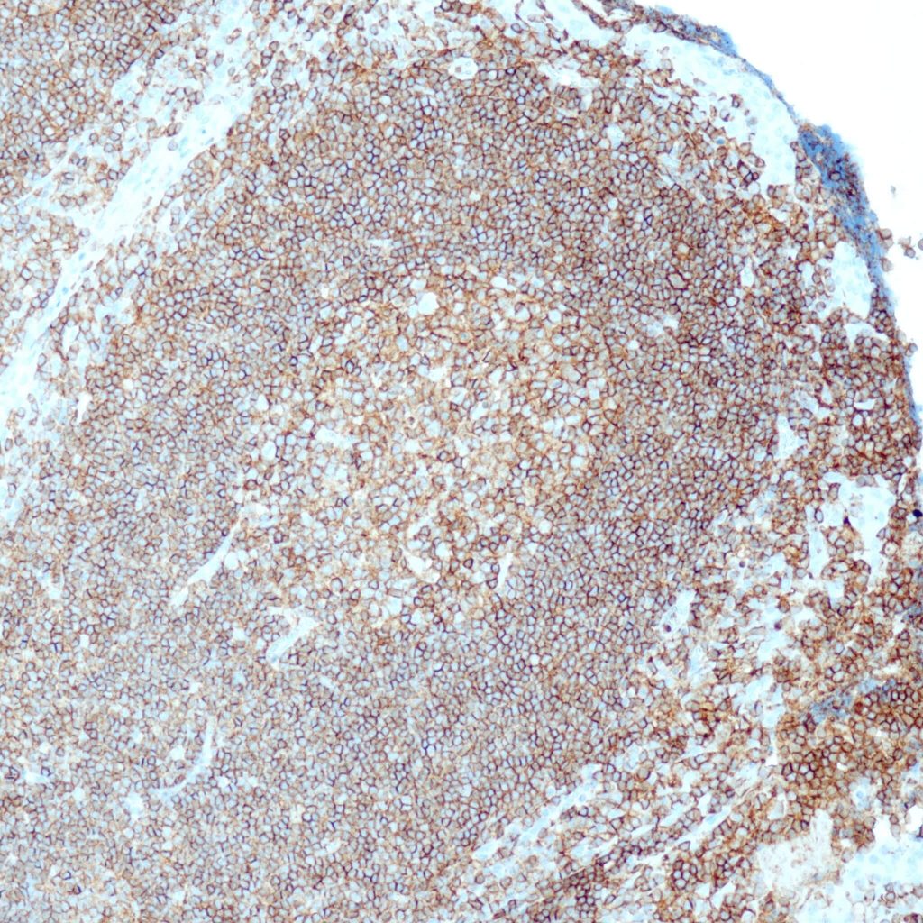 Humane Tonsille gefärbt mit Anti-CD45 (QR106) - deutliche und starke Membranfärbung von praktisch allen Lymphozyten/Histiozyten, Plattenepithelzellen sind negativ.