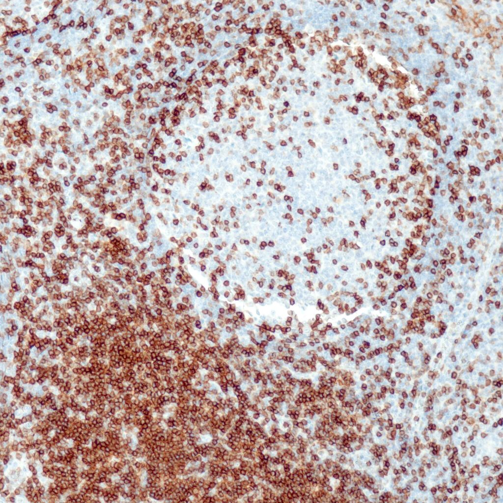 Humane Tonsille gefärbt mit Anti-CD5 (QR111) - starke und deutliche Membranfärbung der T-Zellen in der interfollikulären T-Zone und im Keimzentrum. Verstreute B-Zellen in der Mantelzone zeigen eine schwache bis mäßige, aber deutliche membranöse Färbereaktion.