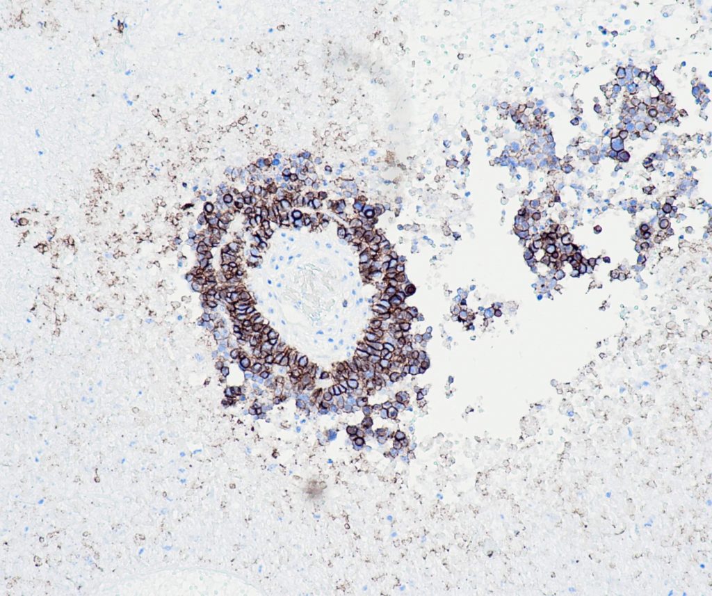 Humane Hirnmetastase gefärbt mit Anti-CD56 (QR044) - starke und deutliche Membranfärbung der Tumorzellen.