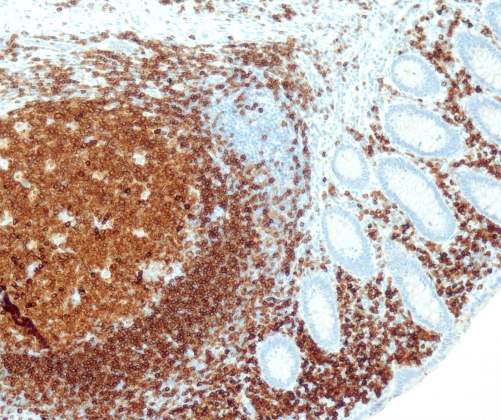 Human appendix stained with anti-CD79a (QR033) - strong and distinct membranous staining of virtually all B-cells. Plasma cells situated in lamina propria mucosa display a strong cytoplasmic reaction. T-cells and epithelial cells are negative.