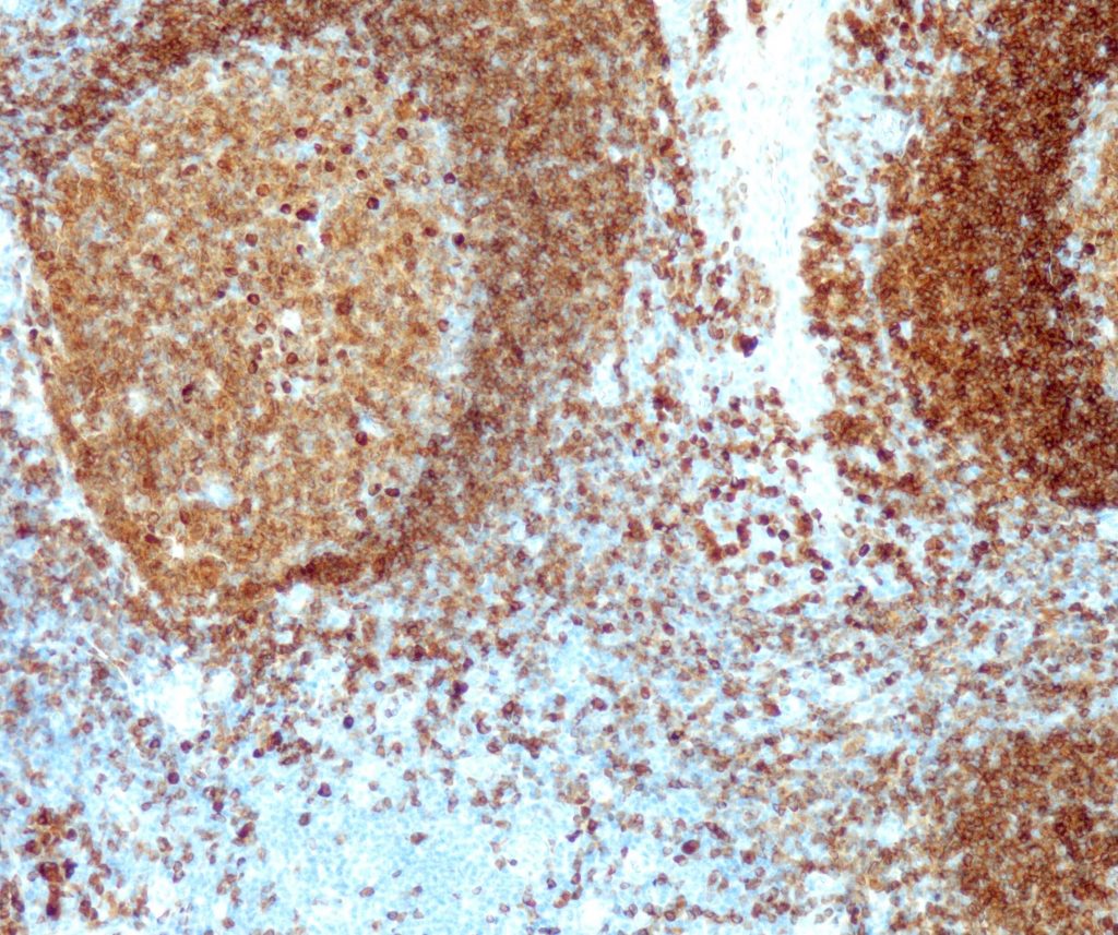 Humane Tonsille gefärbt mit Anti-CD79a (QR033)  - starke und deutliche Membranfärbung von B-Zellen der Mantelzone, während B-Zellen des Keimzentrums eine mäßige bis starke, überwiegend membranöse Färbereaktion aufweisen. Plasmazellen und aktivierte B-Zellen im Spätstadium zeigen eine starke zytoplasmatische Färbereaktion.