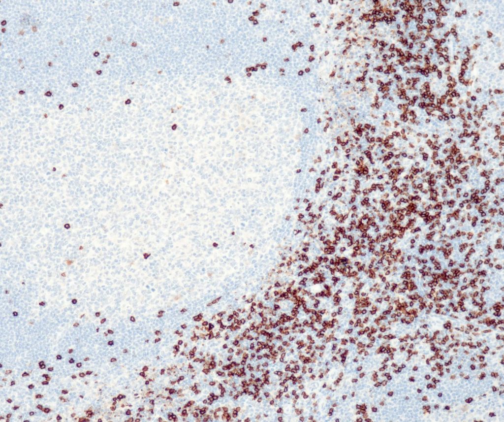 Humane Tonsille gefärbt mit Anti-CD8 (QR068) - starke und deutliche Membranfärbung von Suppressor-/zytotoxischen T-Zellen, andere Zellen sind negativ (einschließlich B-Zellen, Stromazellen oder Plattenepithelzellen).