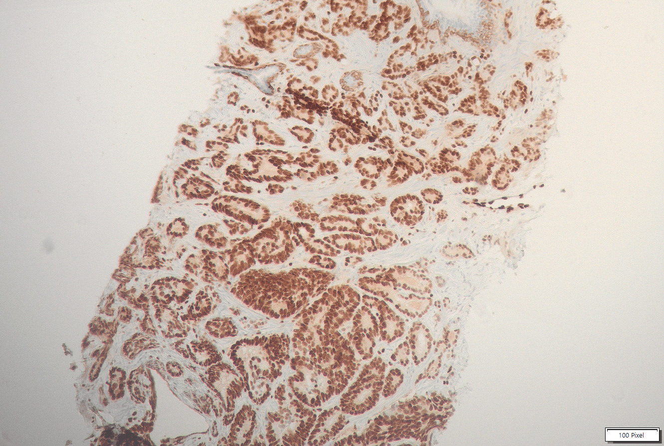 Humanes Prostatakarzinom gefärbt mit Anti-CK5/CK6/ERG-Cocktail (QR027/QR028/QR040).