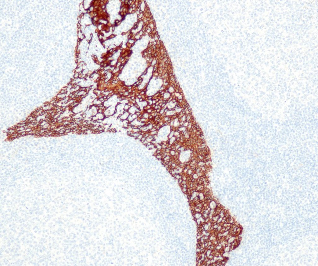 Humane Tonsille gefärbt mit einem Anti-CK5/CK6-Cocktail (QR027/QR028).