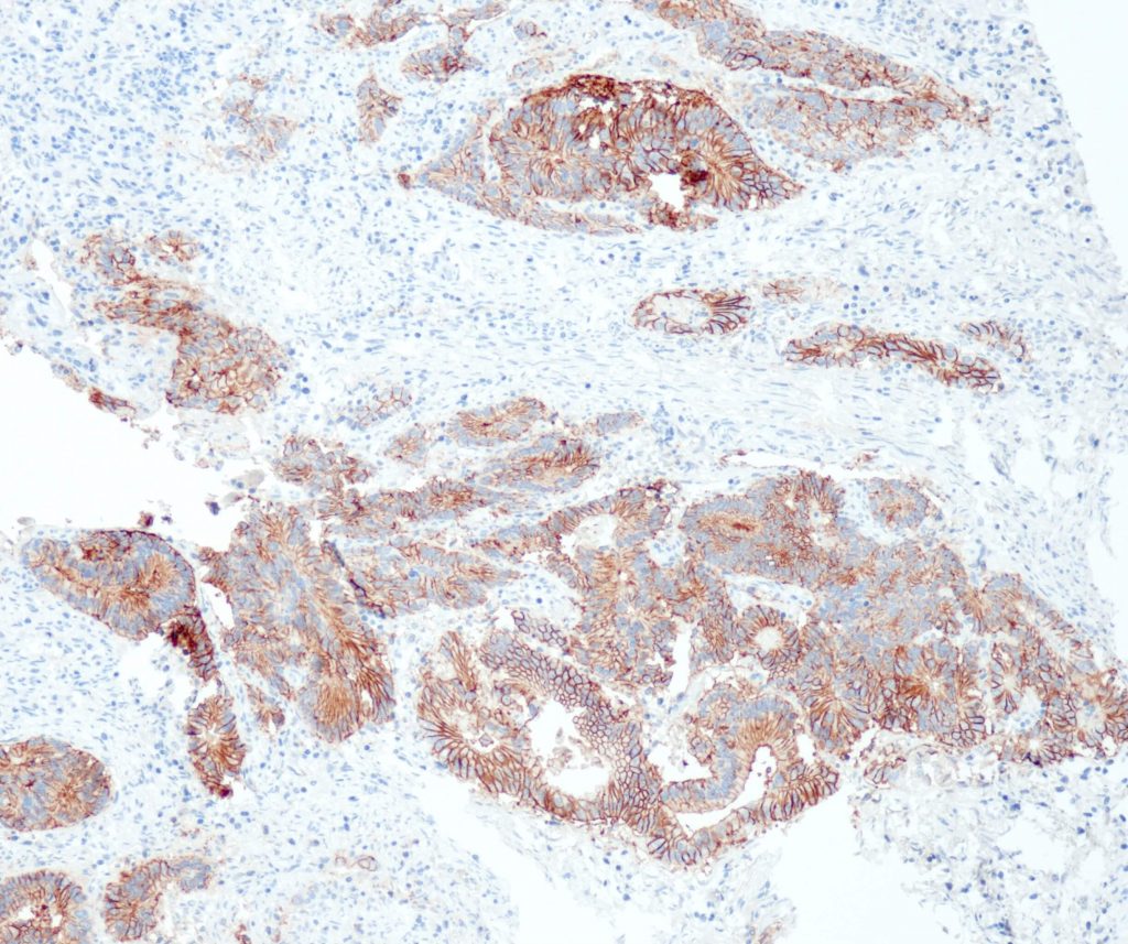 Human colon adenocarcinoma stained with anti-Cadherin 17 (QR098) - strong membranous staining of tumor cells.