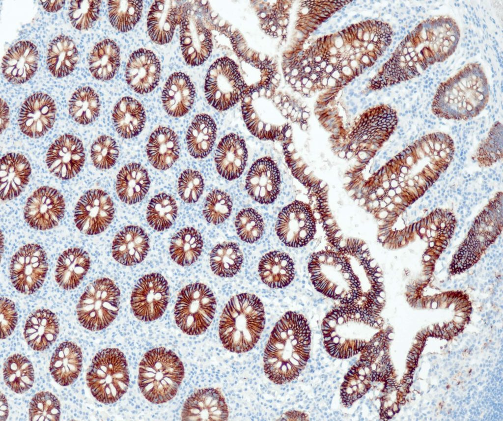 Humaner Dickdarm gefärbt mit Anti-Cadherin 17 (QR098) - starke Membran- und Zytoplasmafärbung in allen Epithelzellen, nicht epitheliale Zellen sind negativ.