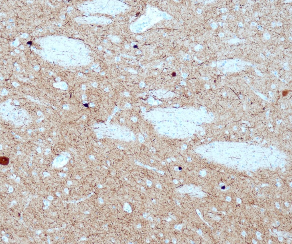 Human brain stained with anti-Calretinin (QR059).