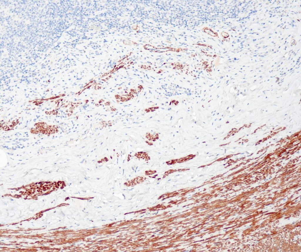 Humaner Blinddarm gefärbt mit Anti-Desmin (QR026) - starke und deutliche zytoplasmatische Färbung der glatten Muskelzellen der Lamina muscularis propria und der Myofibroblasten, die die Epithelzellen auskleiden.
