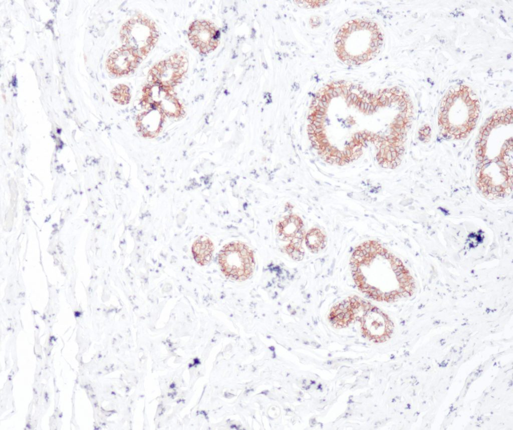 Humanes duktales Mammakarzinom gefärbt mit Anti-E-Cadherin (QR035) - mäßige bis starke Membranfärbung der Tumorzellen.