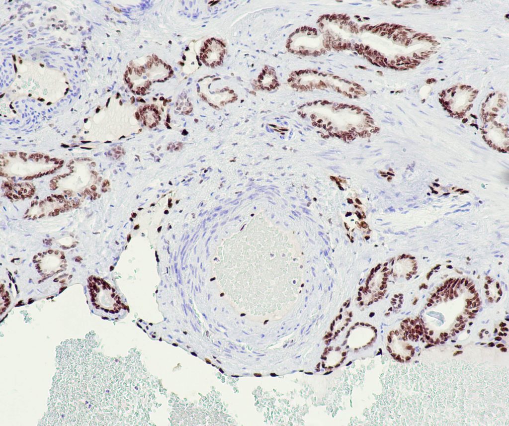 Humanes Prostatakarzinom gefärbt mit Anti-ERG (QR040).
