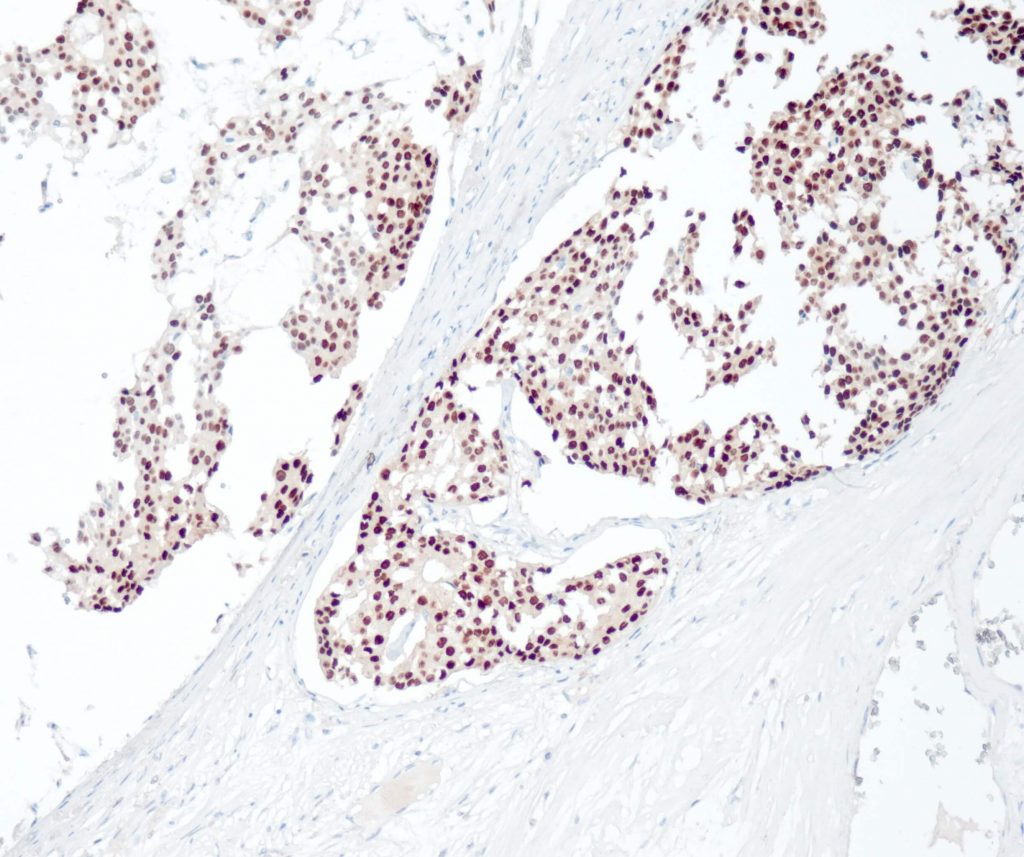 Humanes Mammaadenokarzinom gefärbt mit Anti-ER (QR013) - starke und deutliche Kernfärbung der Tumorzellen.