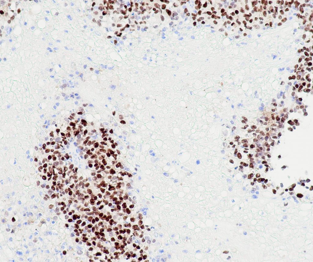 Humanes urotheliales Karzinom gefärbt mit Anti-GATA3 (QR018) - starke und deutliche Kernfärbung der Tumorzellen.