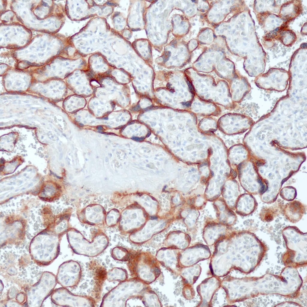 Humane Plazenta gefärbt mit Anti-Glypican 3 (QR103) - mäßige bis starke zytoplasmatische Färbung in praktisch allen Synzytiotrophoblasten und Zytotrophoblasten, während eine schwache, aber deutliche Färbereaktion in verstreuten villösen Stroma- und Endothelzellen zu sehen ist.