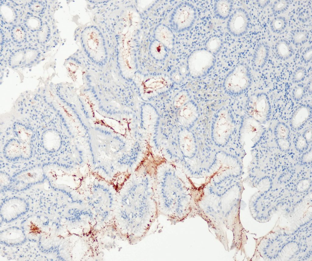 Humaner H. pylori infizierter Magen gefärbt mit Anti-H. pylori (QR091).