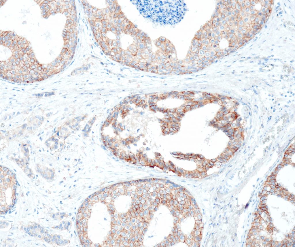 Humanes invasives Mammaadenokarzinom gefärbt mit Anti-Her2/Neu (QR003) - Membranfärbung der Tumorzellen.