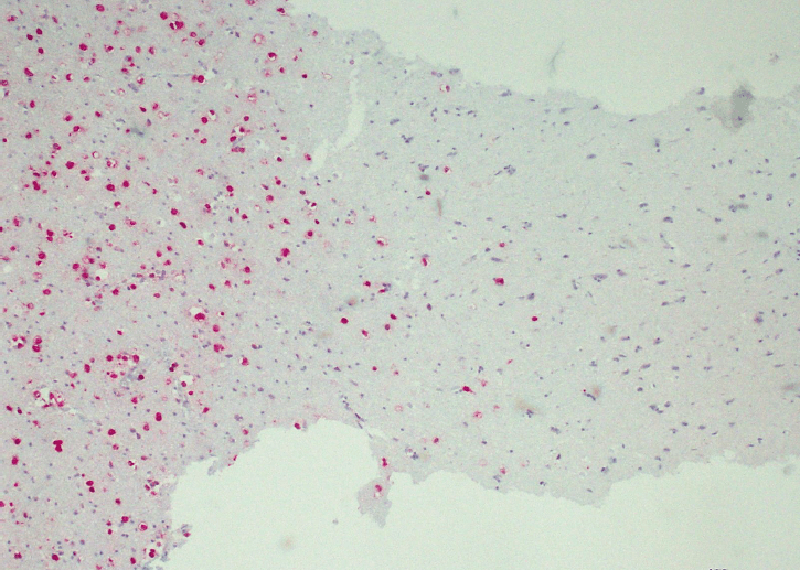 Humanes Astrozytom - IDH1 R132H positiv - mit Ausdehnung in angrenzendes gesundes Hirngewebe gefärbt mit Anti-IDH1 R132H (QM002).