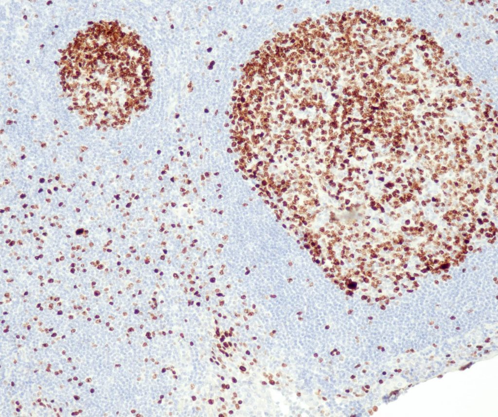 Humane Tonsille gefärbt mit Anti-Ki-67 (QR015) - starke und deutliche Kernfärbung der B-Zellen im Keimzentrum, die große Mehrheit der B-Zellen in der Mantelzone ist negativ.