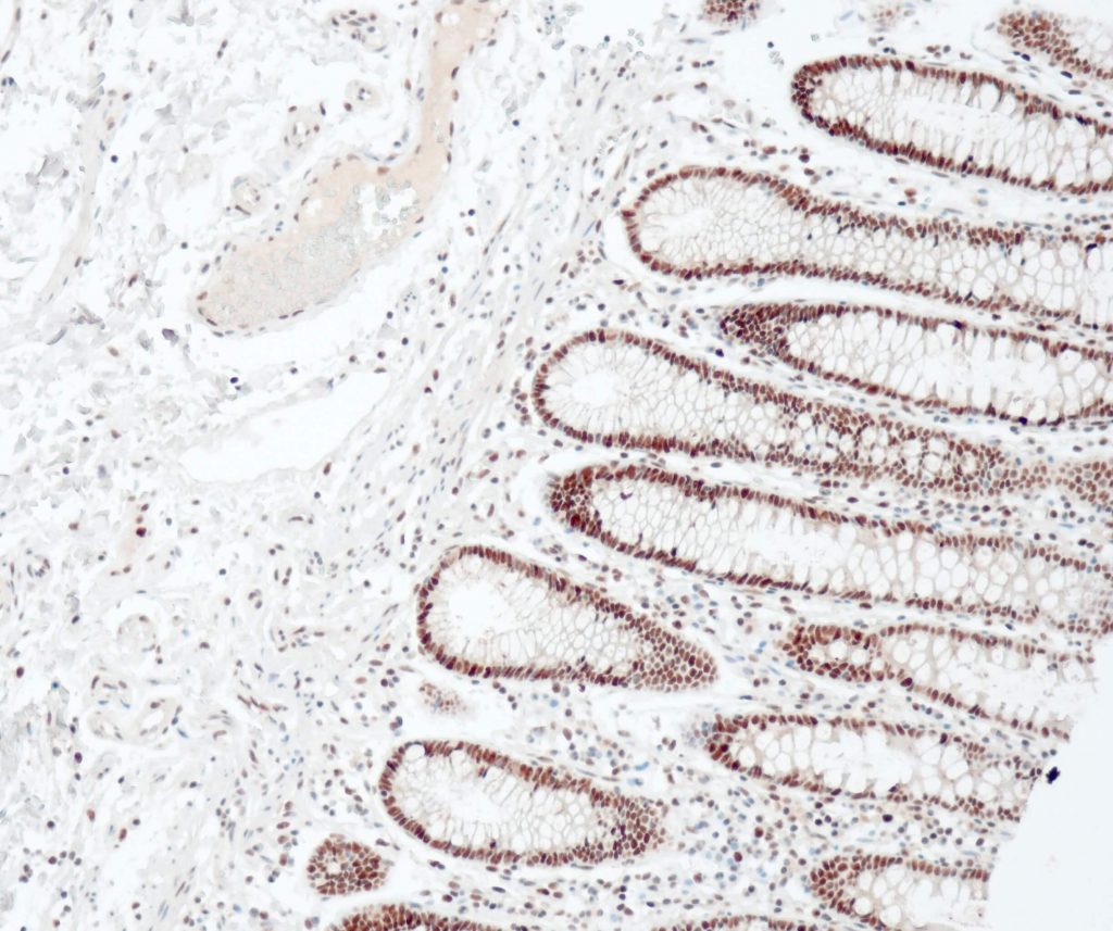 Humanes Adenokarzinom des Kolon gefärbt mit Anti-MLH1 (QM003) - starke Kernfärbung der Tumorzellen.