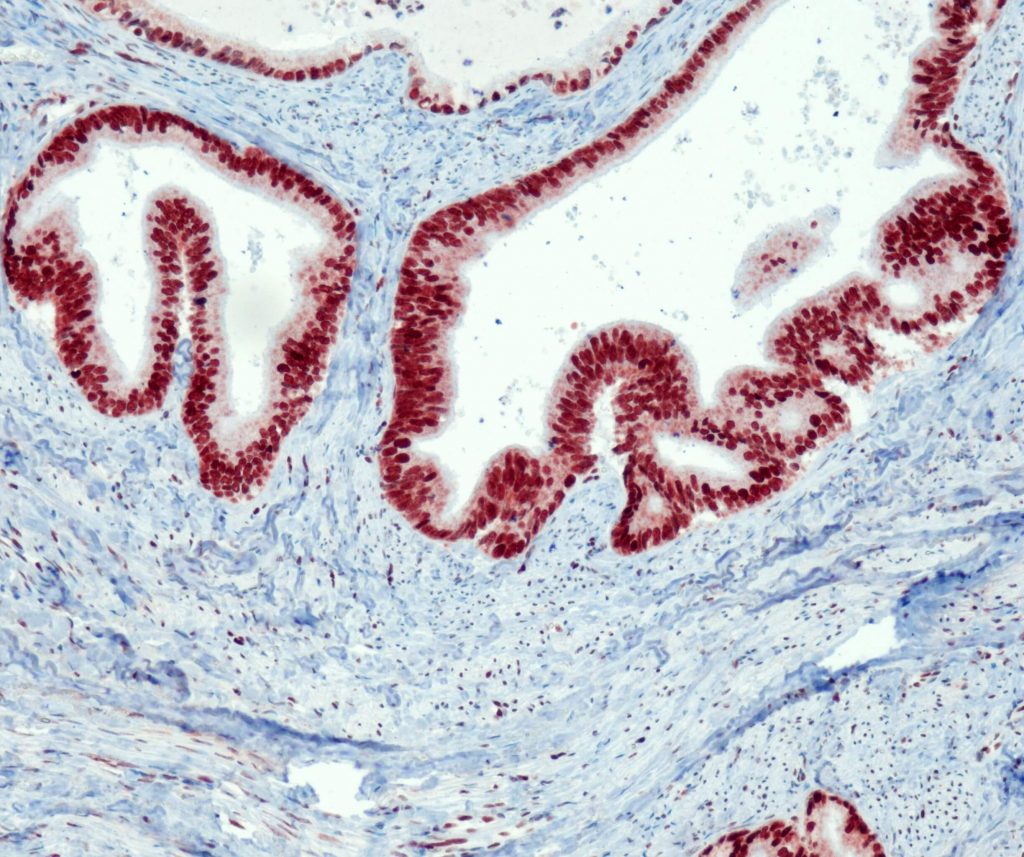 Humanes Adenokarzinom des Kolon gefärbt mit Anti-MSH2 (QR010) - starke Kernfärbung der Tumorzellen.