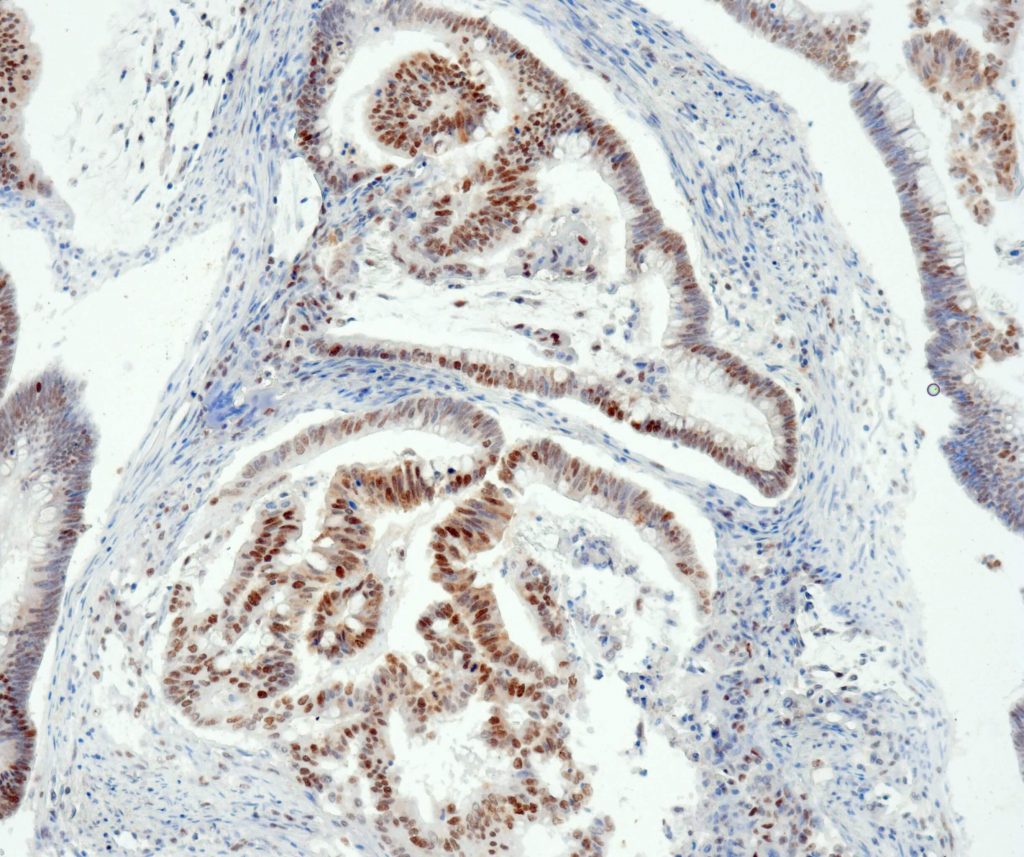 Humanes Adenokarzinom des Kolon gefärbt mit Anti-MSH6 (QR011) - starke Kernfärbung der Tumorzellen.