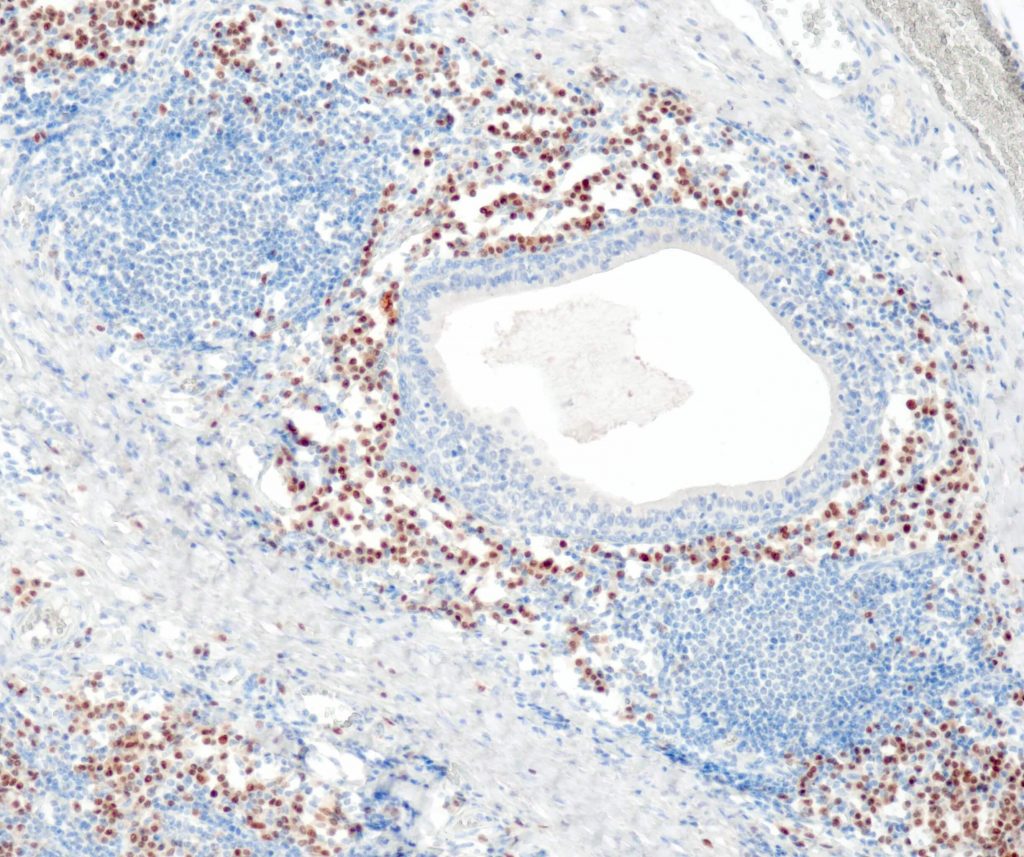 Humane Tonsille gefärbt mit Anti-MUM1 (QR075).