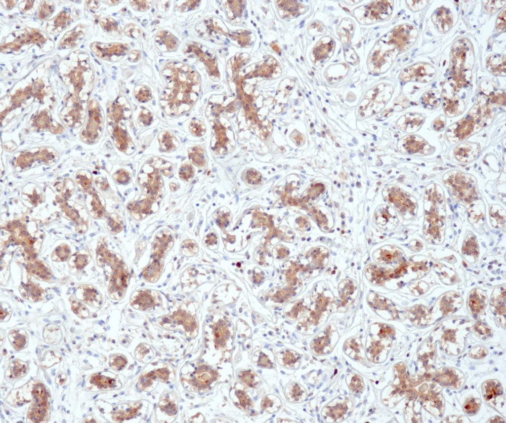 Humanes Brustgewebe gefärbt mit Anti-Mammaglobin (QR080) - zytoplasmatische Färbung von apokrinen metaplastischen Zellen und einigen duktalen Epithelzellen.
