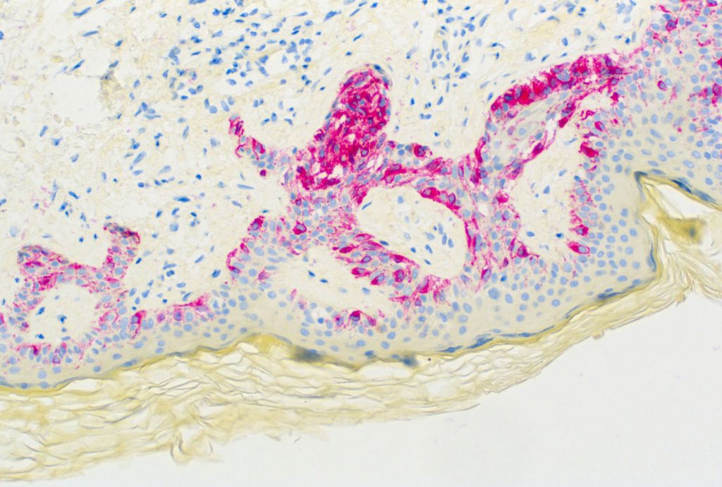 Humanes Melanom gefärbt mit Anti-Melanoma (HMB-45) - starke zytoplasmatische Färbung der Tumorzellen.
