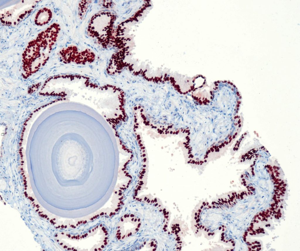 Humane Prostatahyperplasie gefärbt mit Anti-NKX3.1 (QR055) - starke Kernfärbung von Epithelzellen der Prostatadrüsen.