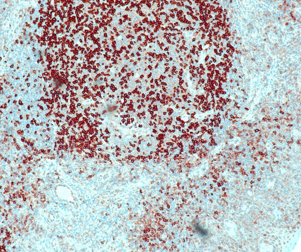 Humane Tonsille gefärbt mit Anti-PD-1 (QR002) - Zytoplasma- und Membranfärbung von T-Zellen im Keimzentrum.