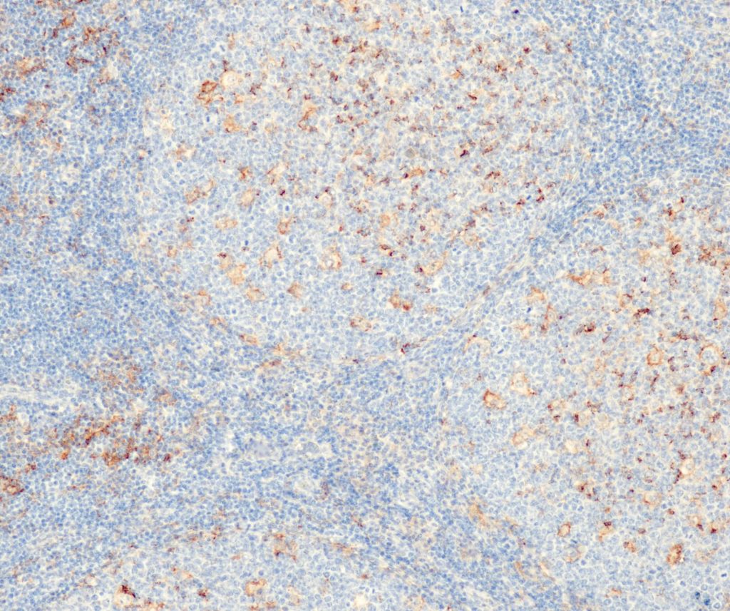 Humane Tonsille gefärbt mit Anti-PD-L1 (QR001) - Membranfärbung von Makrophagen im Keimzentrum, die überwiegende Mehrheit der lymphoiden Zellen ist negativ.