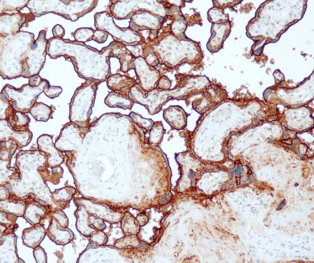Humane Plazenta gefärbt mit Anti-PLAP (QR084) - starke, überwiegend membranöse, aber auch zytoplasmatische Färbung der Zytotrophoblasten und Synzytiotrophoblasten der Plazenta.