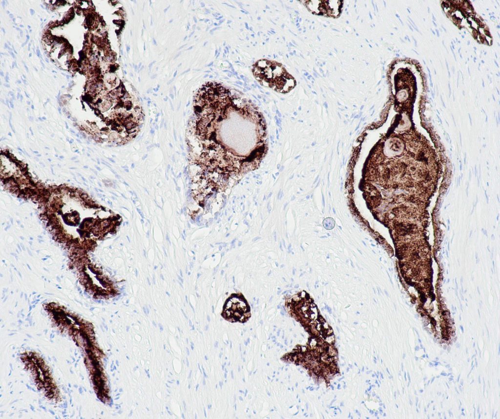 Humane Prostatahyperplasie gefärbt mit Anti-PSA (QR038) - starke zytoplasmatische Färbung der Epithelzellen der hyperplastischen Prostatadrüsen.