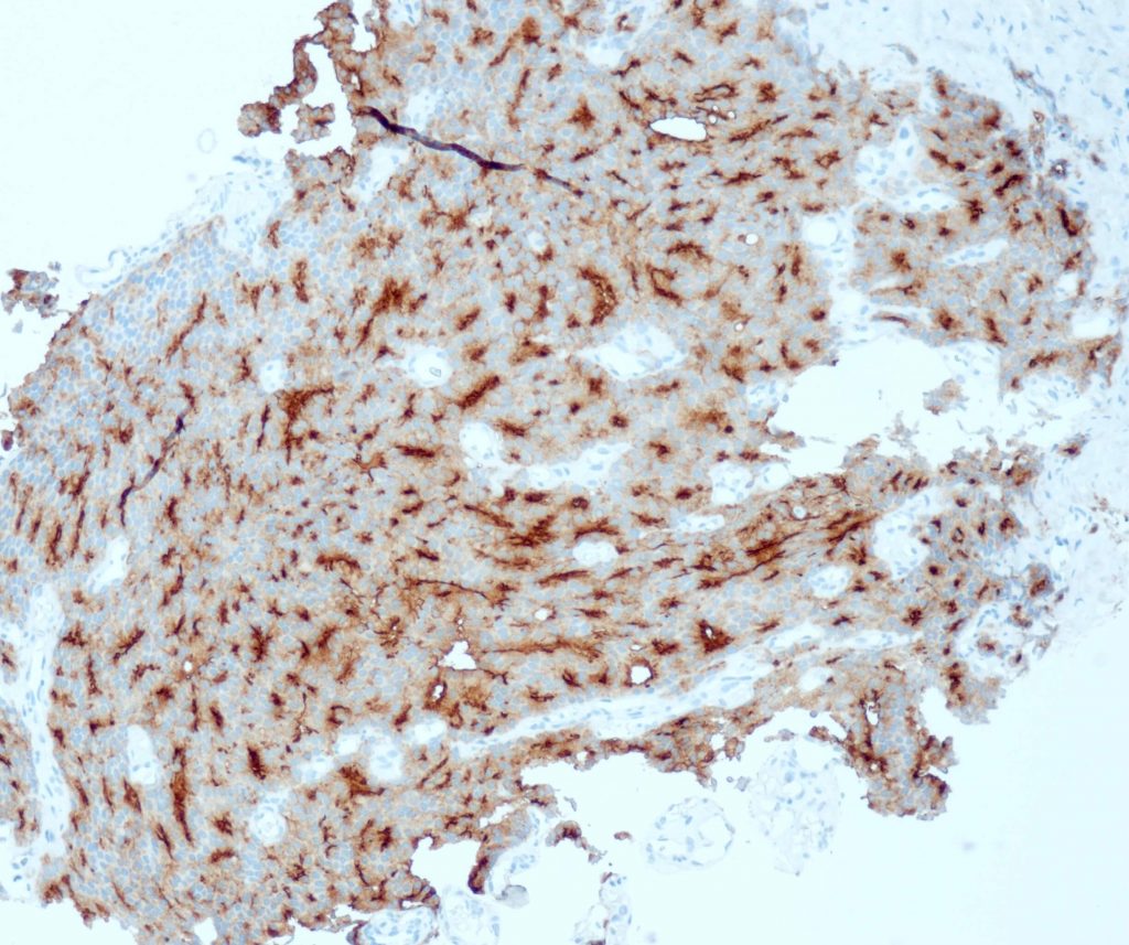 Humanes Adenokarzinom der Prostata gefärbt mit Anti-PSMA (QR079).