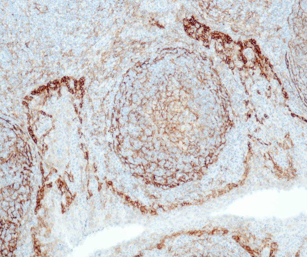 Tonsil stained with anti-Podoplanin (QR048) -  strong staining of the lymphatic
endothelial cells, the follicular dendritic cells in the
germinal centres and the basal squamous epithelial cells.