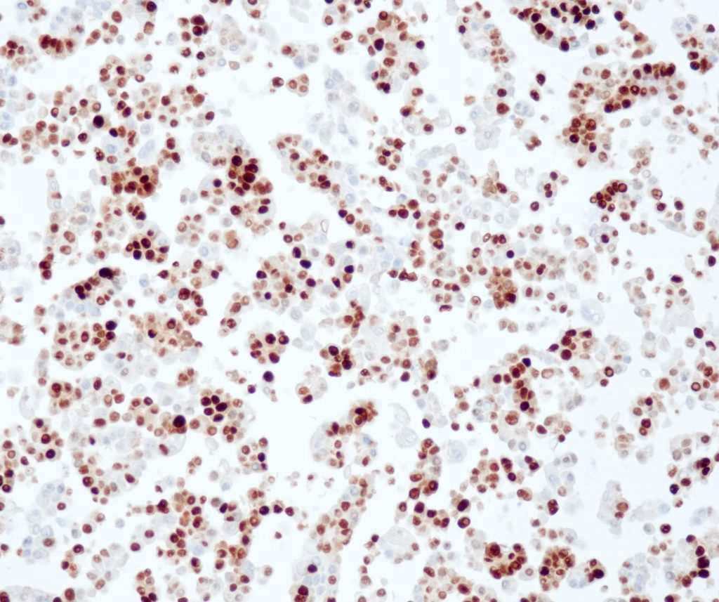 Humanes duktales Mammakarzinom gefärbt mit Anti-Progesterone receptor (QR014) - starke Kernfärbung der Tumorzellen.