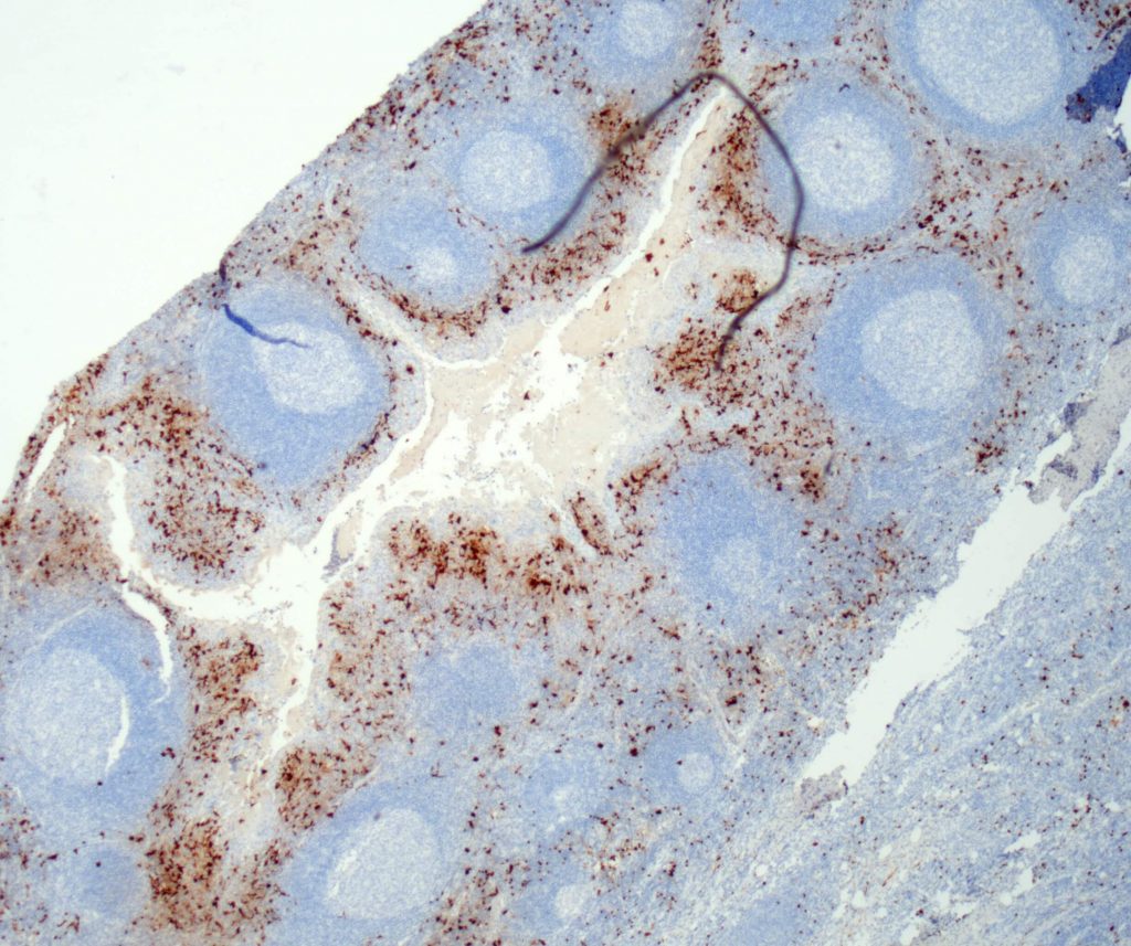 Humane Tonsille gefärbt mit Anti-S100B (QR031) - starke Zellkern- und Zytoplasmafärbung von interfollikulären Makrophagen, dendritischen Zellen und Langerhans-Zellen im Plattenepithel.