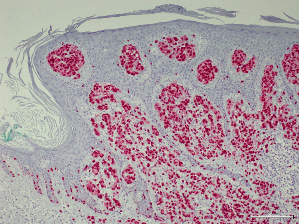 Humanes spitzoides malignes Melanom gefärbt mit Anti-SOX10 (QR006) - deutliche und starke Kernfärbung der Tumorzellen.