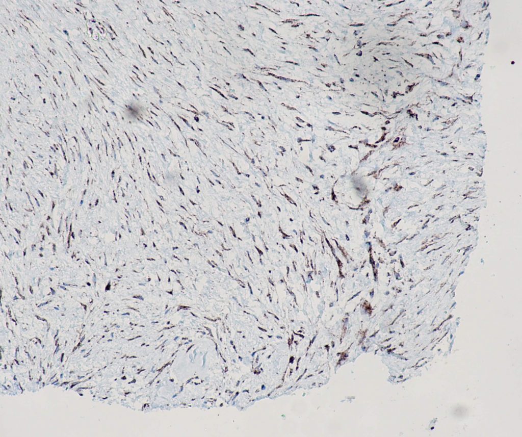 Humaner fibröser Solitärtumor gefärbt mit Anti-STAT6 (QR041) - deutliche und starke Kernfärbung der Tumorzellen.