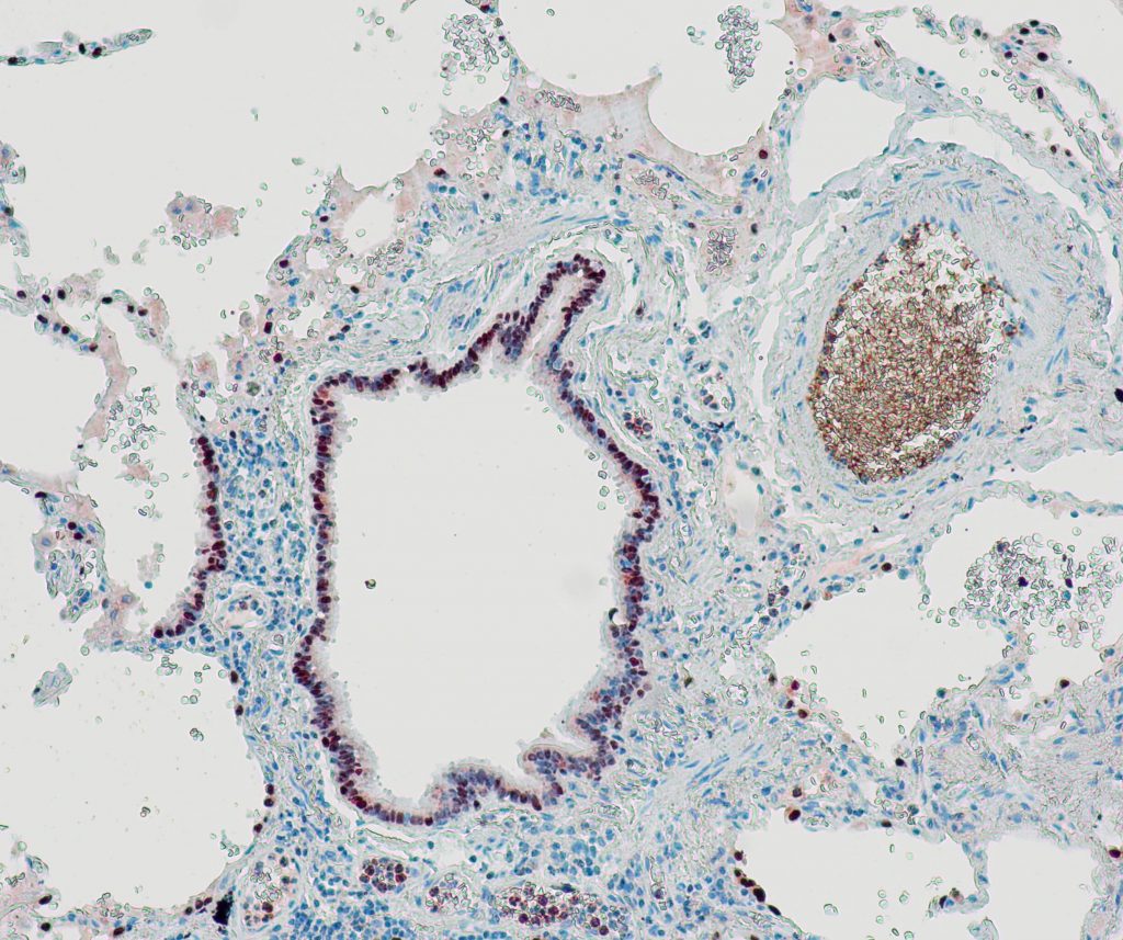 Humanes Lungenadenokarzinom gefärbt mit Anti-TTF-1 (QR046) - starke und deutliche Kernfärbung von Tumorzellen.