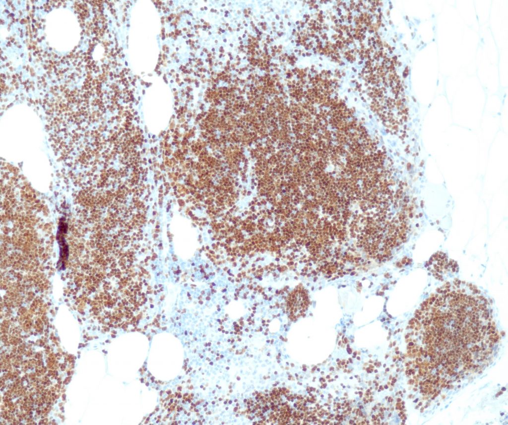 Humanes Thymom gefärbt mit Anti-TdT (QR037) - starke und deutliche Kernfärbung unreifer T-Zellen, die sich mit neoplastischen Zellen des Thymoms vermischen.