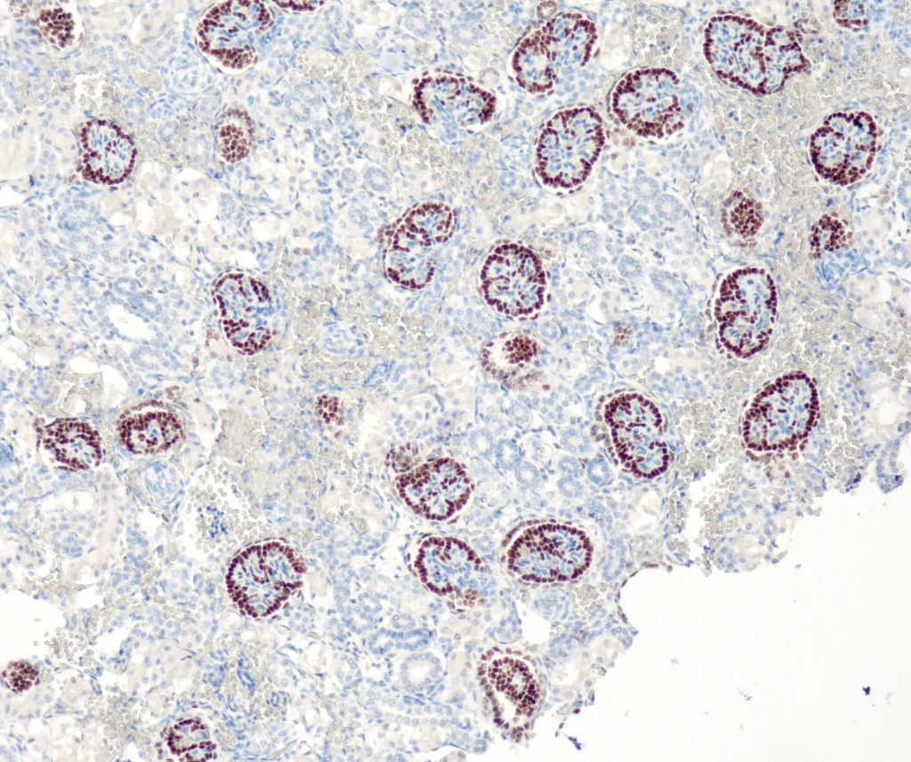 Humane Niere gefärbt mit Anti-WT1 (QR030) - starke und deutliche Kernfärbung von Podozyten und Parietalepithelzellen.