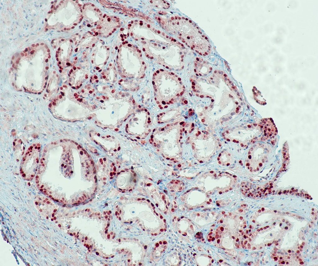 Prostatakarzinom gefärbt mit Anti-c-Myc (QR061) - Kernfärbung von Tumorzellen.